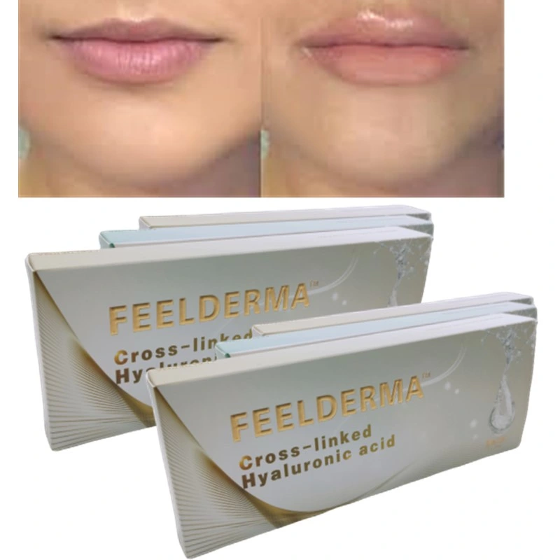 Hyaluronic Acid Dermal Filler for Cosmetic Surgery Collagen Gel Hydro Acid Collagen