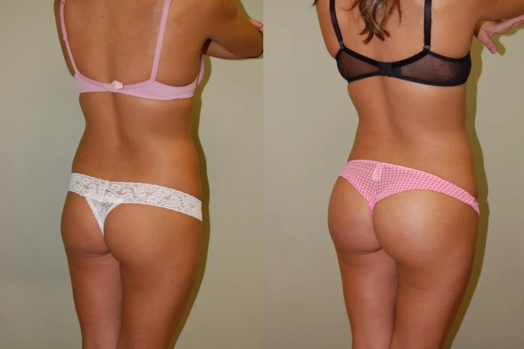 Clinic Aesthetics Beauty and Personal Care Used Boob and Buttocks Ha Dermal Filler