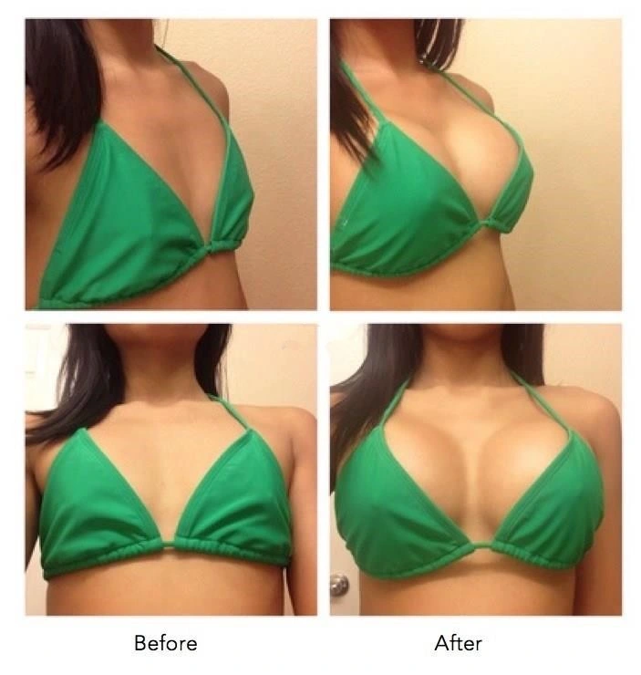 Clinic Used Injectable Ha Dermal Fillers Breast and Buttock Hyaluronic Acid Injection Dermal Fillers