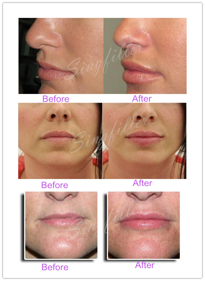 Singfiller Hyaluronic Acid Dermal Filler for Lip Filler (derm 1.0ml)