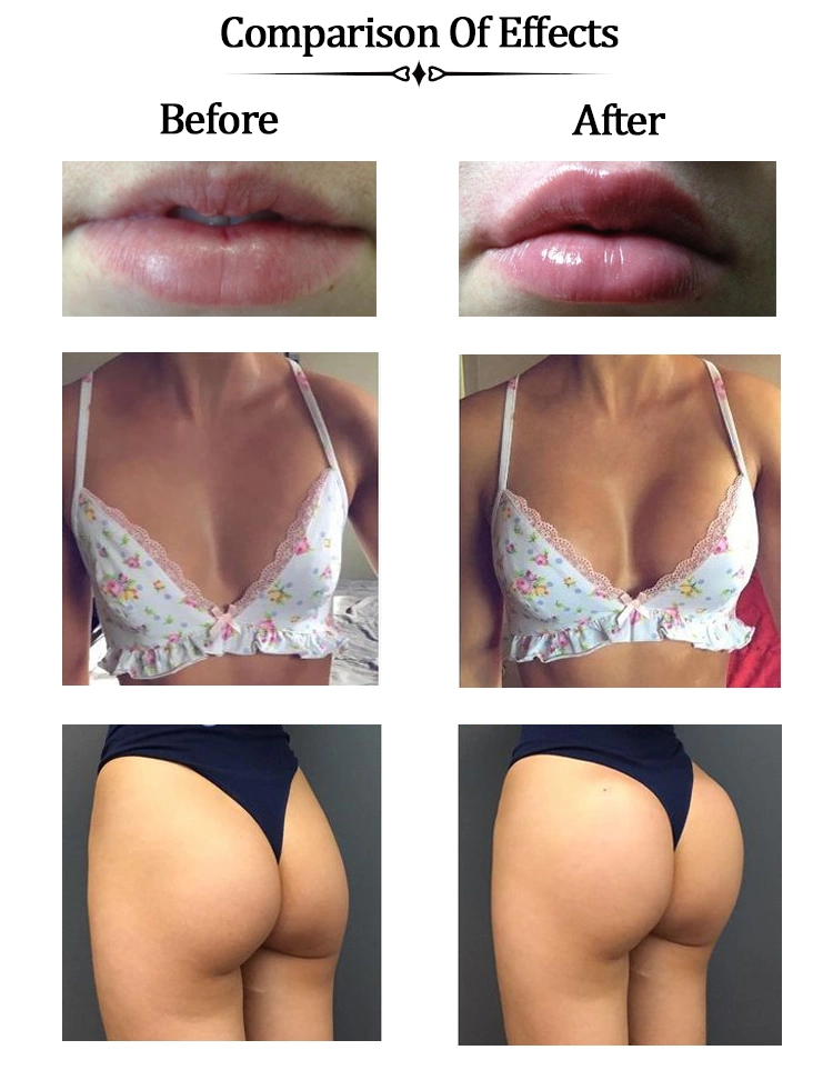 Hot Sale Hyaluronic Acid Dermal Filler Butt Injections with Lidocaine