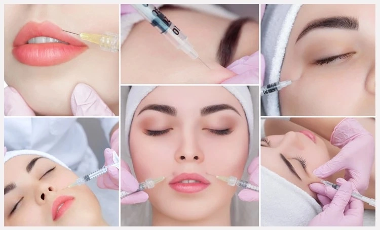 Singfiller Hyaluronic Acid Dermal Filler for Lips, Nasolabial Folds, Cheek