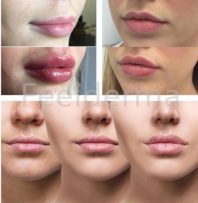 Long Lasting Dermal Fillers Natural Hyaluronic Acid Injection Face Filler