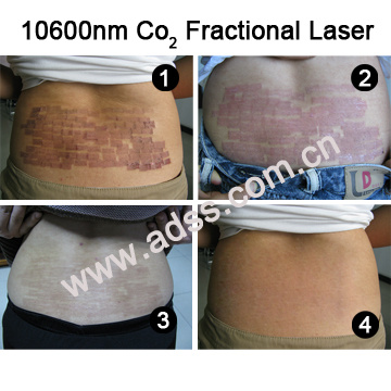 CO2 Fractional Laser Wrinkle Removal Equipment (FG500)