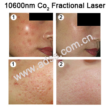 CO2 Fractional Laser Wrinkle Removal Equipment (FG500)