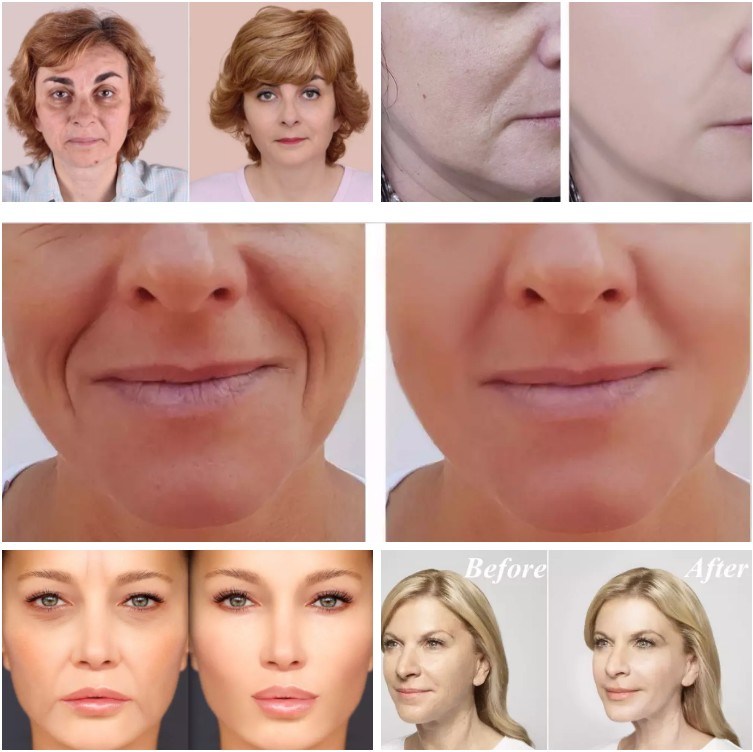 2ml Ha Gel Injection for Deeply Skin Repairing and Anti-Aging