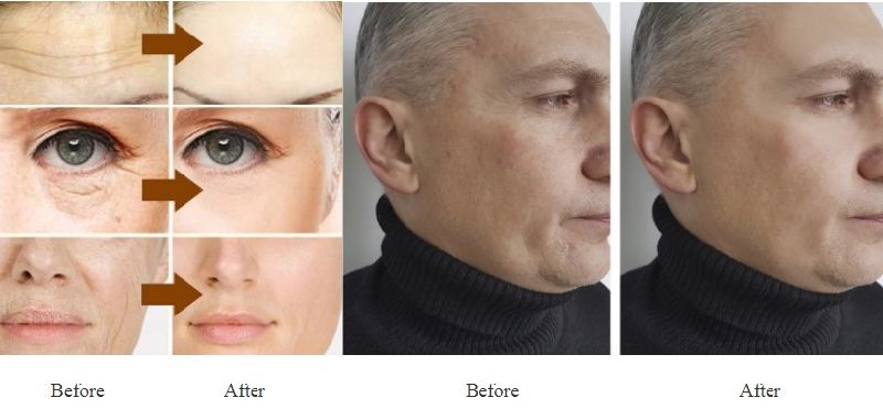 2ml Ha Gel Injection for Deeply Skin Repairing and Anti-Aging