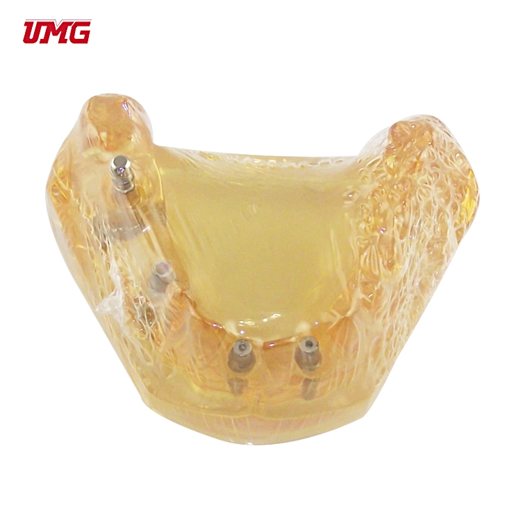 2021 Hot Sale Dental Tooth Model and Implant Model