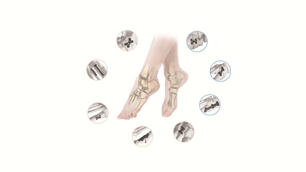 Canwell Medical Hand Foot and Ankle Reconstraction Locking Plate System Surgical Instrument Set