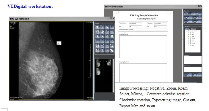 FM-M600 Digital X-ray Mammogram Equipment, Digital Mammography Machine for Breast Cancer Images Mammogram