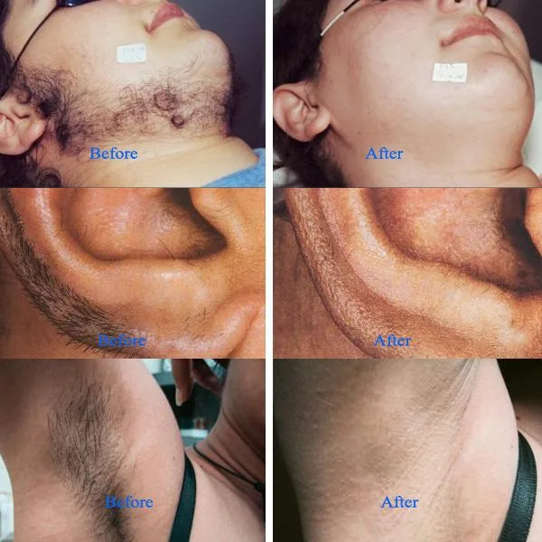 4-in-One IPL Hair Removal and Skin Tenderness Machine
