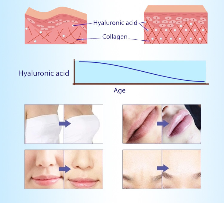 Fine/Derm/Deep/Ultra-Deep 10ml Injectable Filler Hyaluronic Acid Gel