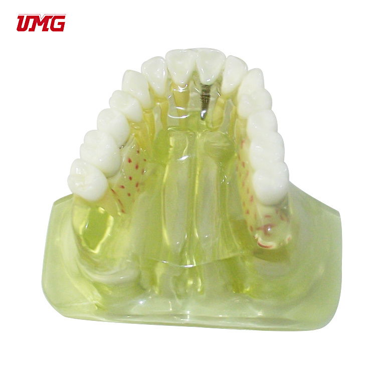 Implant with Ball Attachments Model Teaching Tooth Model Practice Model