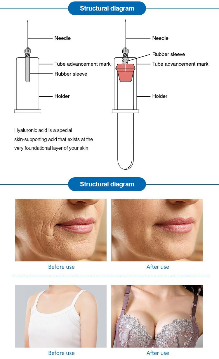 Long Lasting 2 Ml Lip Enlargement Breast Lifting Hyaluronic Acid Dermal Filler