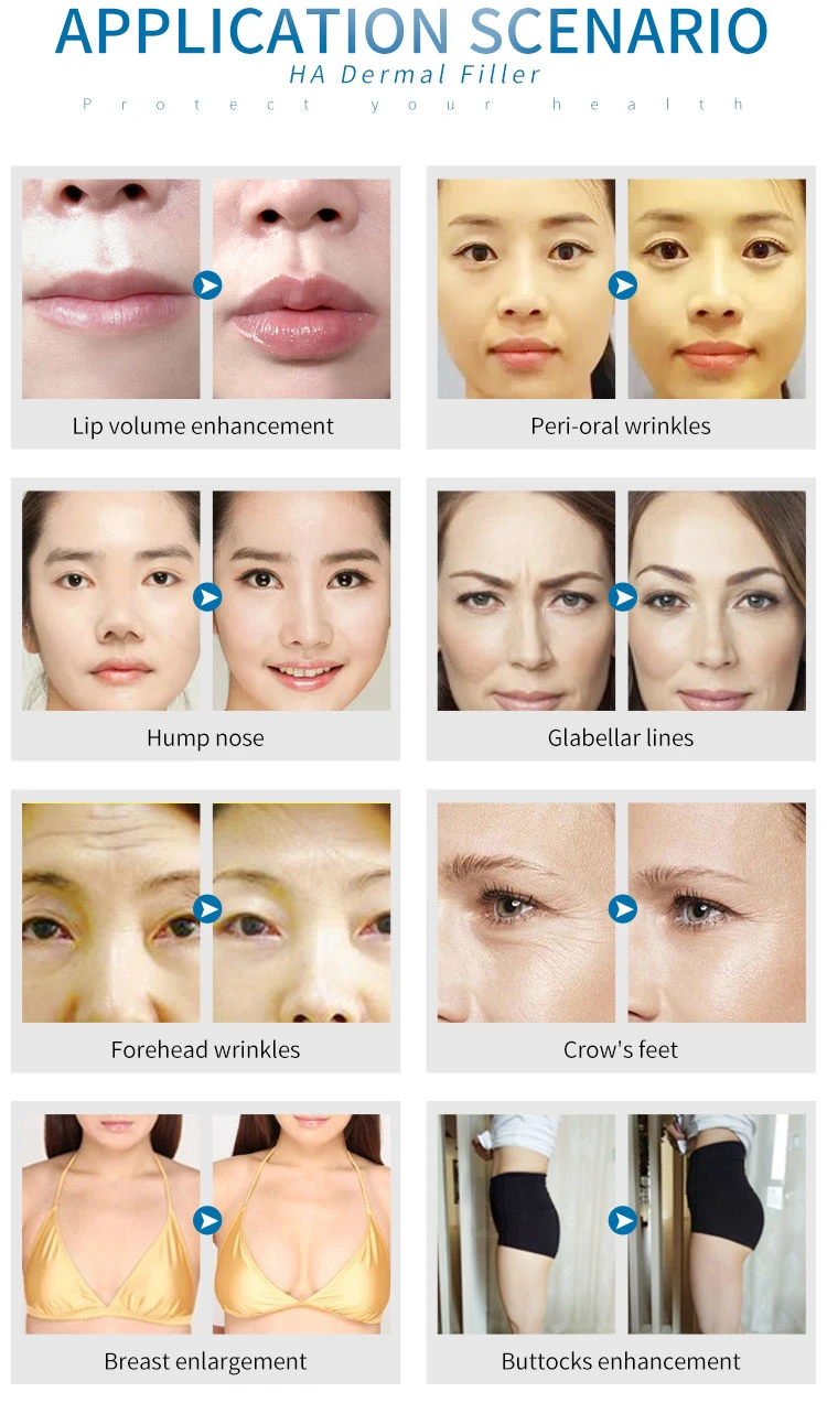 Hyaluronic Acid Nasolabial Folds Iniettabile Augmentation Expansion Dermal Filler