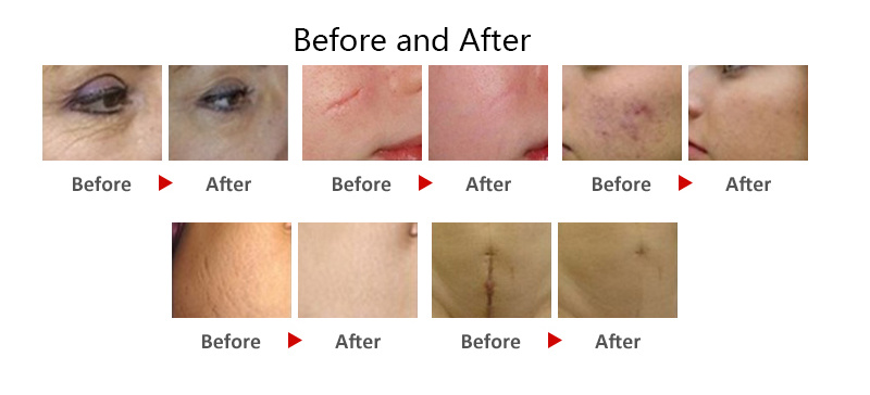 Trends 2021 Hybrid Fractional Laser Machine Depigmentation Fractional CO2 Laser Parts for Acne Scars