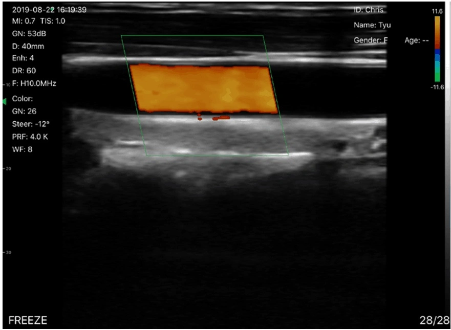 128 Elements Wireless Ultrasound Probe with Linear Probe